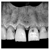 Ridge alterations after tooth extraction