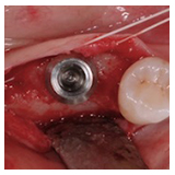 Implantat-Chirurgie Teil II