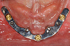 Edentulous-bar