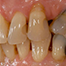 Implantatfreilegung in funktionellen Bereichen - Basics