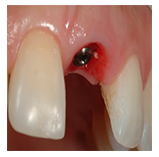 Immediate implant placement -factors influencing the esthetic success