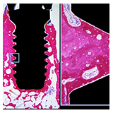 Osseointegration